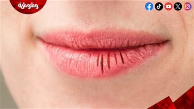 أسباب جفاف الشفاه وطرق طبيعية للحفاظ على نعومتها