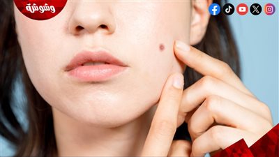 أسباب ظهور الحبوب المفاجئة وطرق التعامل معها بسرعة