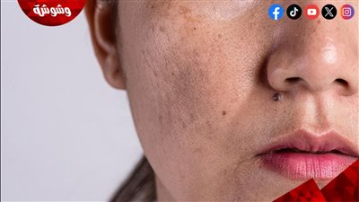 التصبغات الجلدية.. أسبابها وطرق الوقاية منها في المنزل