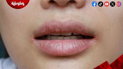 تشقق زوايا الفم.. علامة صحية لا يجب تجاهلها