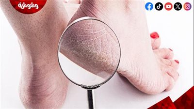 وصفة منزلية فعالة للتخلص من تشقق كعب القدم.. خطوات بسيطة تمنحك نعومة وترطيبًا 