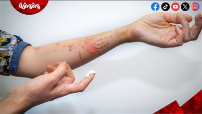 طرق علاج الحروق البسيطة في المنزل بوصفات طبيعية آمنة