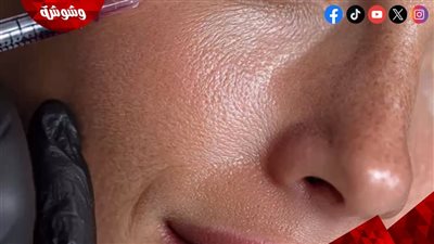 نصائح هامة قبل الذهاب لجلسات البوتوكس.. اعرفيها