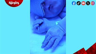 الصفار عند حديثي الولادة.. دليل الأم الشامل للتمييز بين العارض الطبيعي والخطر