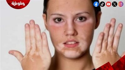 استشاري أمراض جلدية يكشف أسرار مرض البهاق 