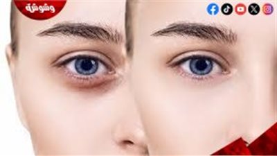 وداعًا للهالات السوداء.. وصفة منزلية بسيطة تمنح عينيكِ مظهرًا أكثر إشراقًا