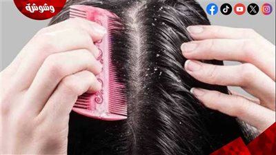 طريقة سهلة لتنظيف فروة الرأس والتخلص من القشرة.. تعرفي عليها