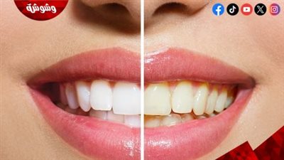 أسنان أكثر بياضًا.. حقيقة خلطة الزنجبيل والقرفة